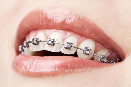 Orthodontic (Braces)