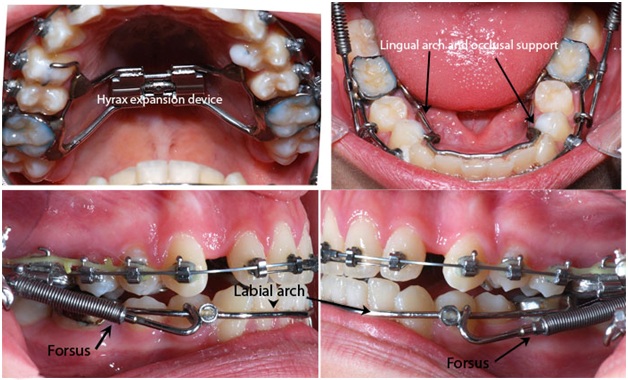 Ask Your Fort Worth Dentist: Should I Get Metal or Clear Braces? Archstone  Dental & Orthodontics, TX